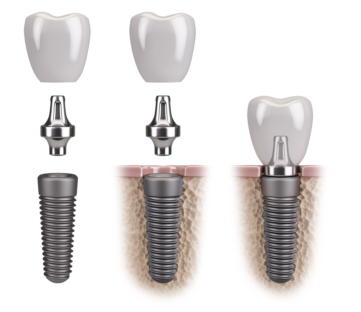 65b284f80f2ee3a7ae54e2d7_Dental Implant cut out