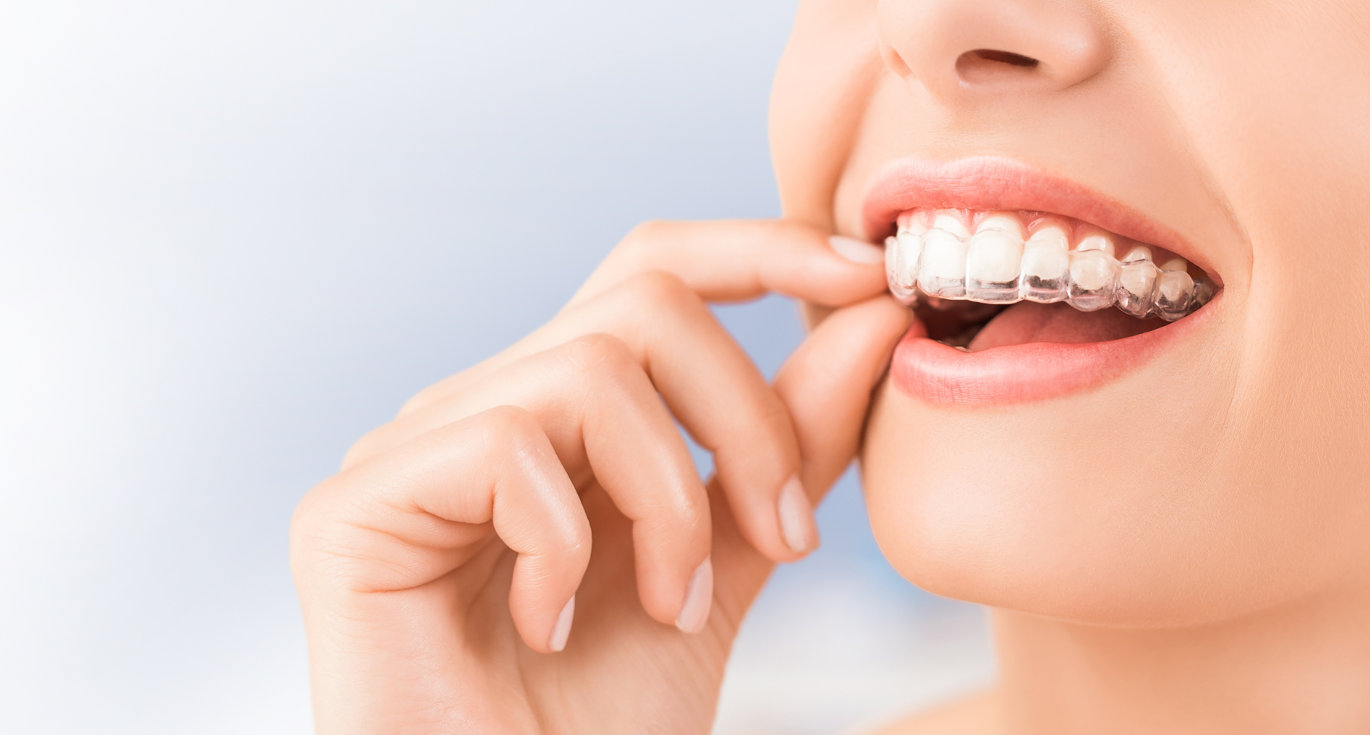 invisalign dentistry 1